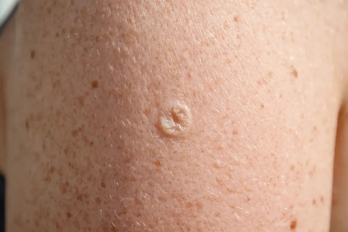 Small round indented smallpox vaccine scar on an upper arm