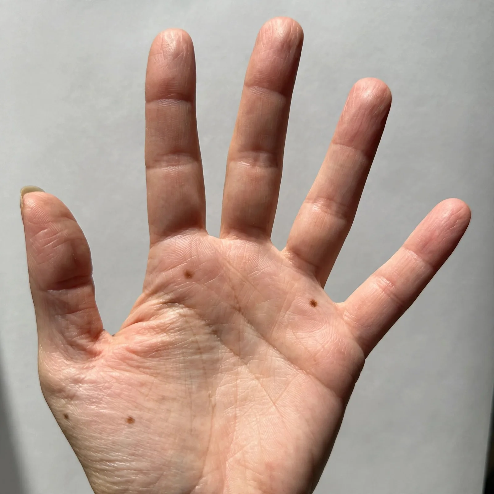 Finger length ratio comparison of index and ring fingers